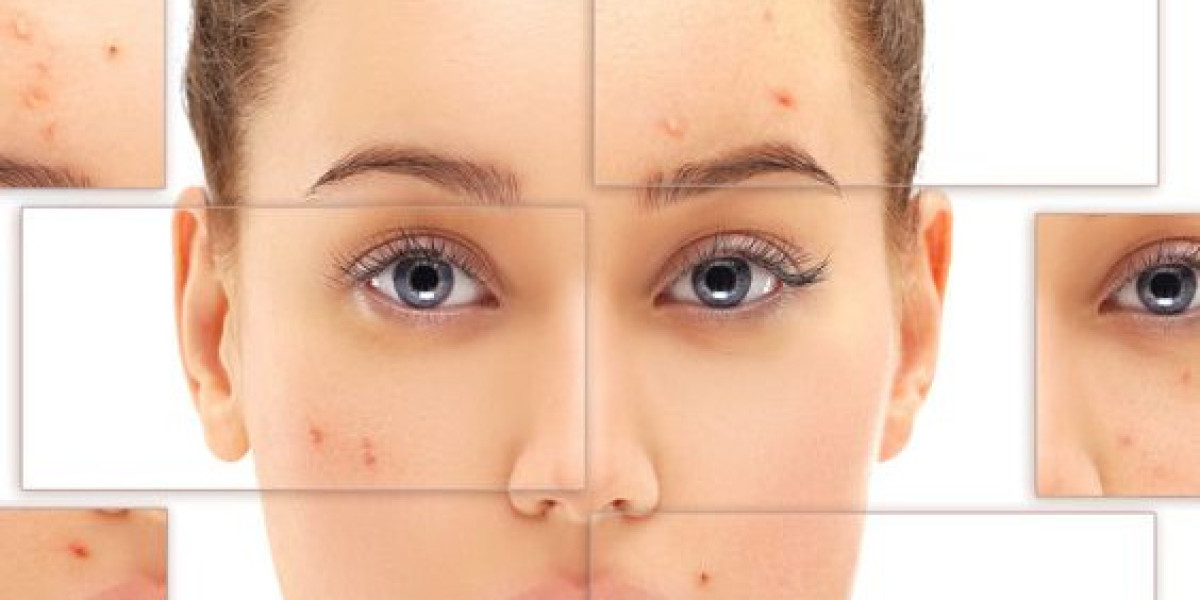 Step-by-Step Process of Laser Acne Treatment in Islamabad