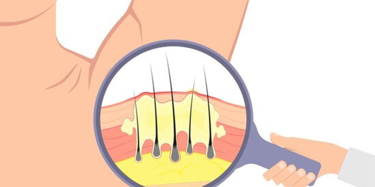 Hidradenitis Suppurativa Market: Size, Trends, and Strategic Outlook
