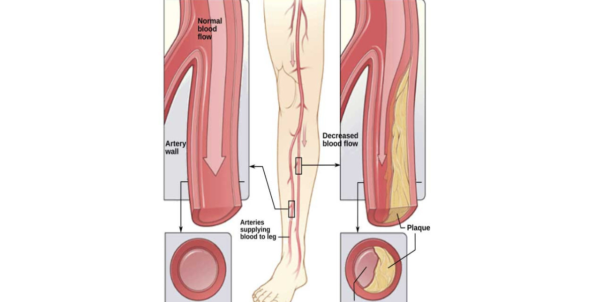Peripheral Arterial Disease Market: Size, Trends, and Growth Opportunities