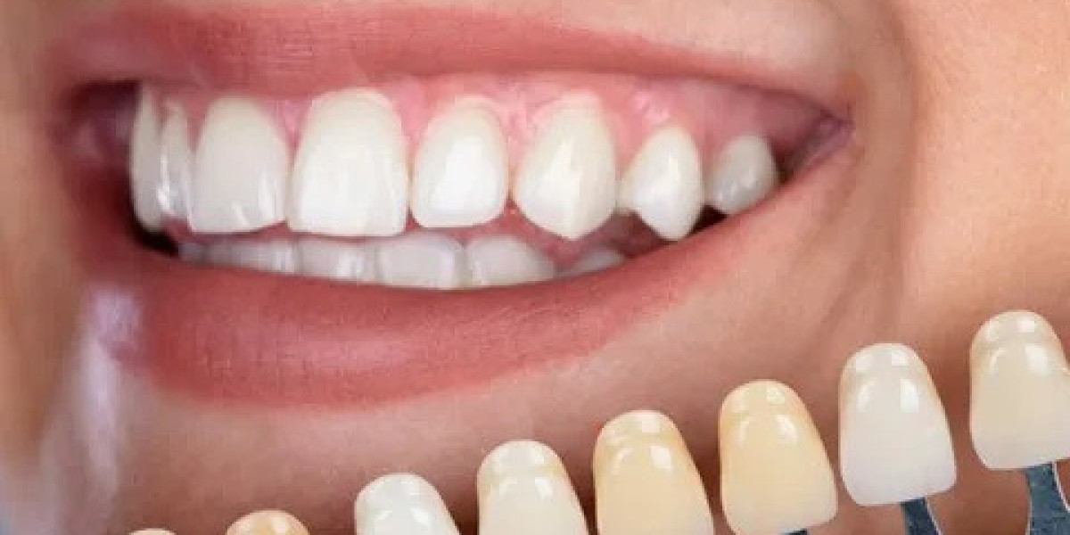 Long-Term Care Tips for Dental Crowns in Islamabad