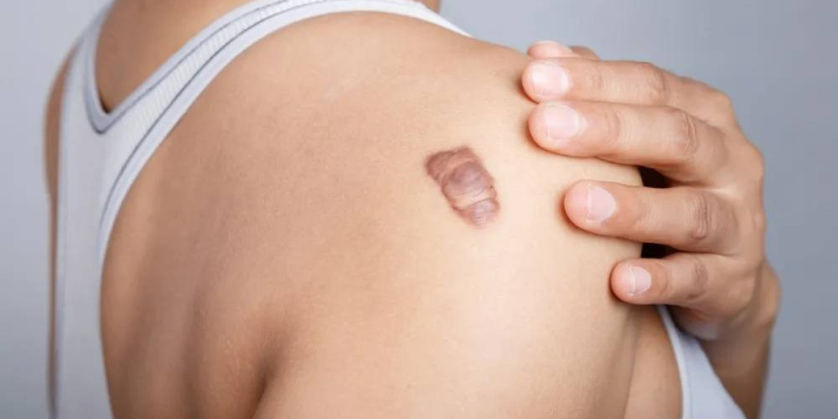 Best Age for Keloid Treatment in Islamabad