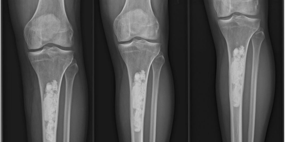 Innovations Shaping the Latin America Bone Graft And Substitutes Market