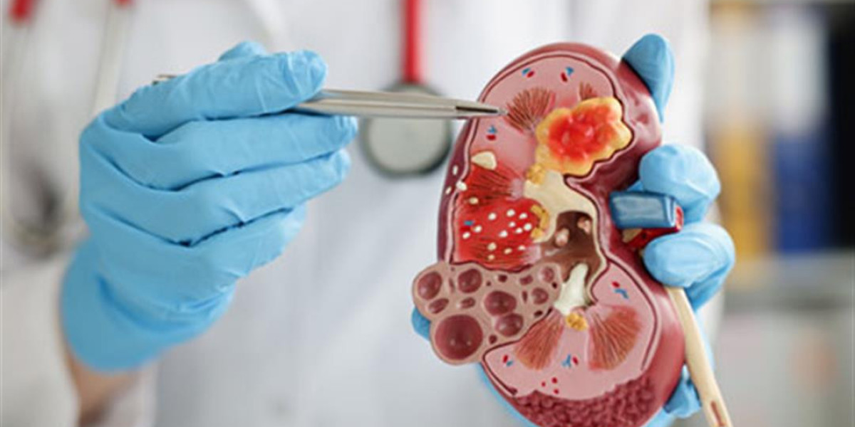 Exploring Next-Gen Kidney Stone Management Devices in Healthcare
