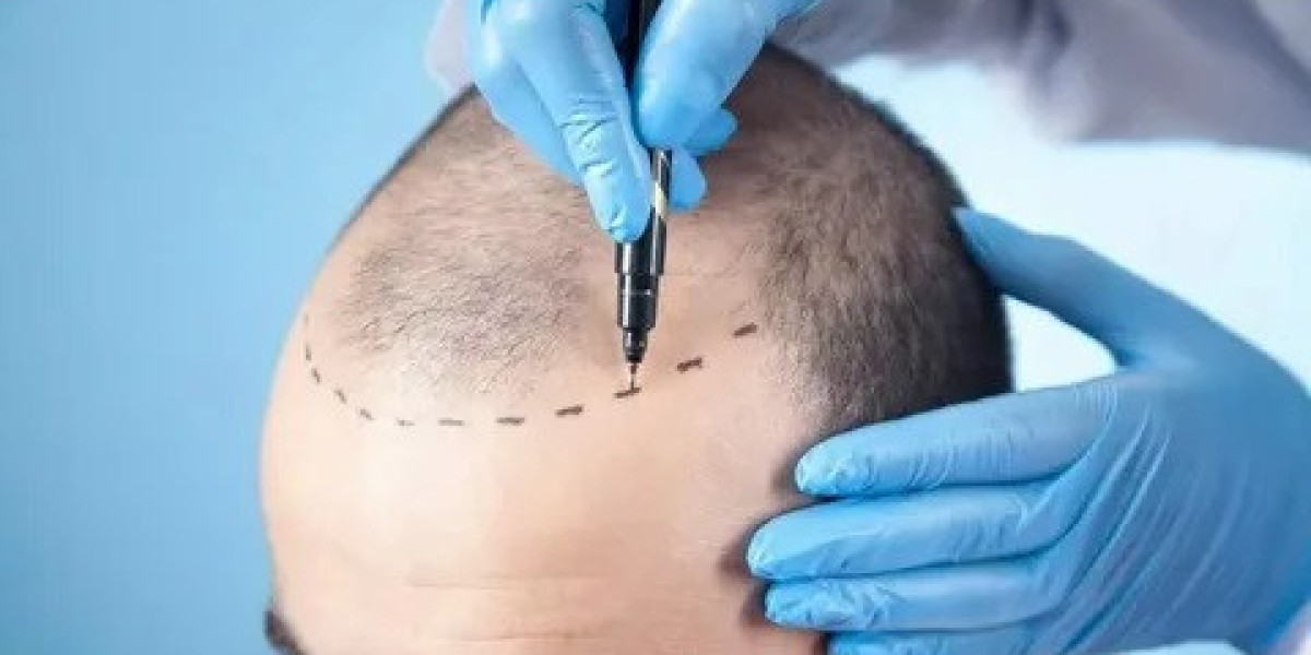 Hair Transplant in Islamabad: Long-Term Benefits