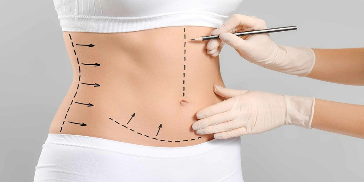How Much Does Full Body Liposuction Cost in Islamabad?