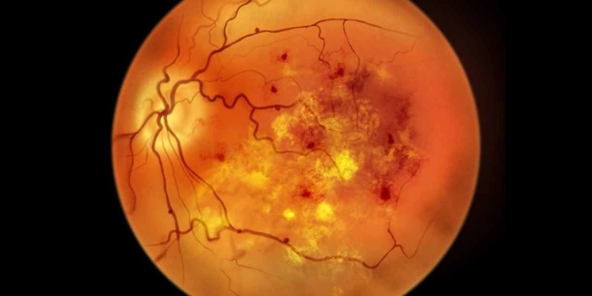 Diabetic Retinopathy Market Growth Driven by Anti-VEGF & AI Diagnostics