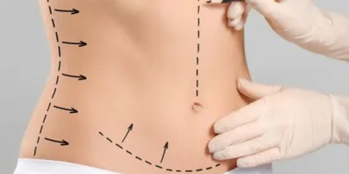 Circumferential Abdominoplasty in Islamabad: How It Differs from Liposuction