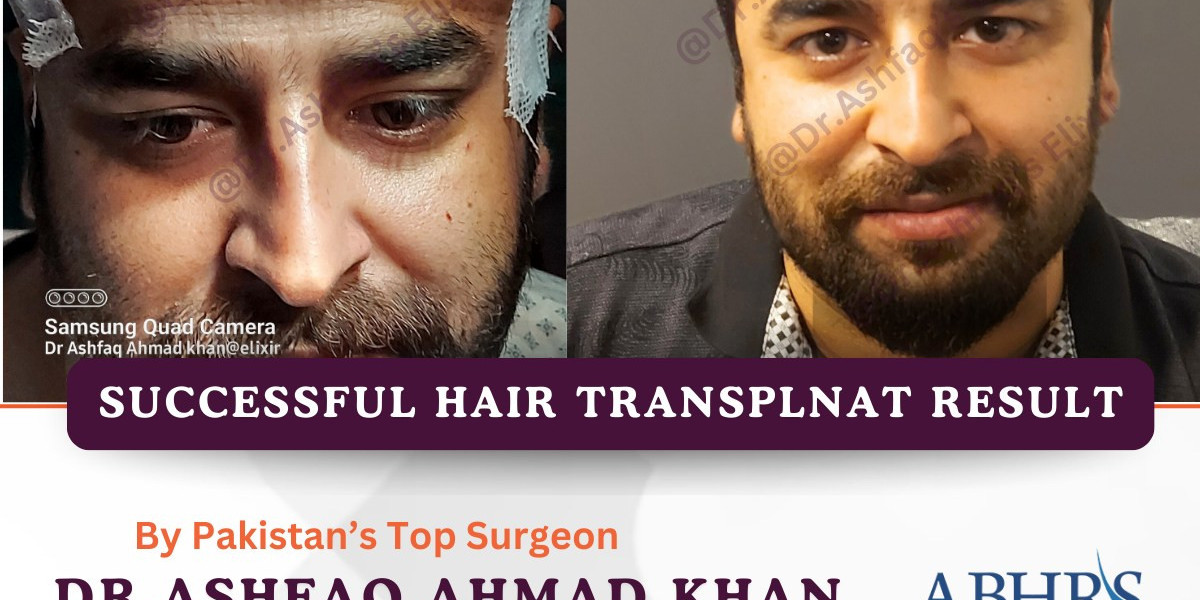 A Hair Growth Timeline of FUE Hair Transplant
