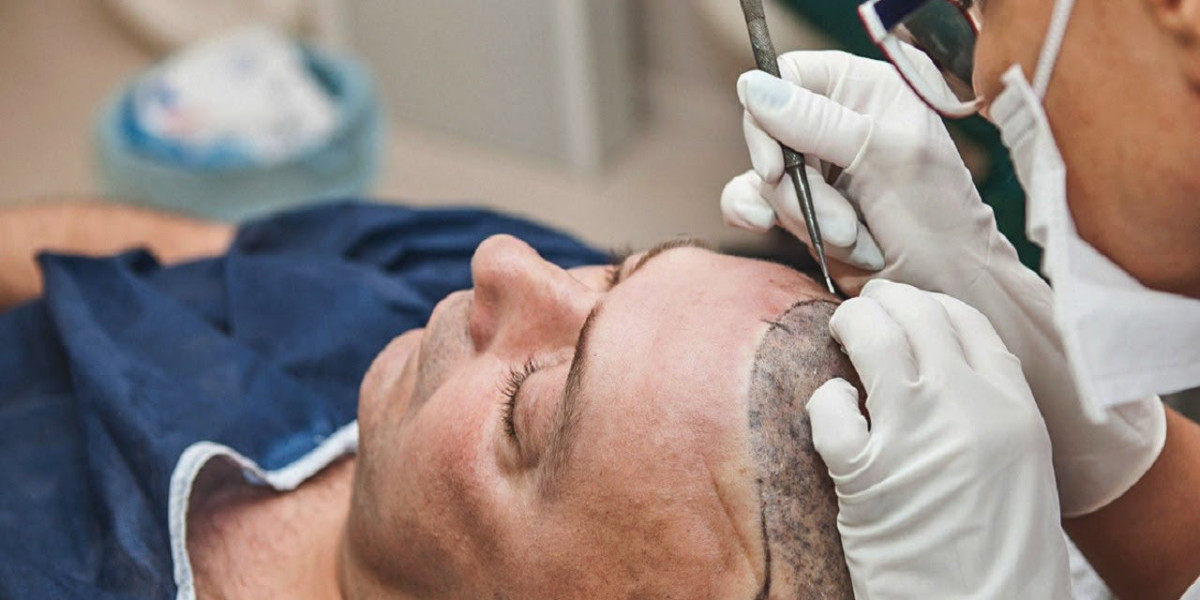 Beard and Mustache Transplant in Islamabad
