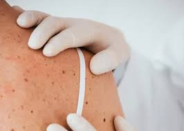 Why are Skin Cancer Checks so Essential ...